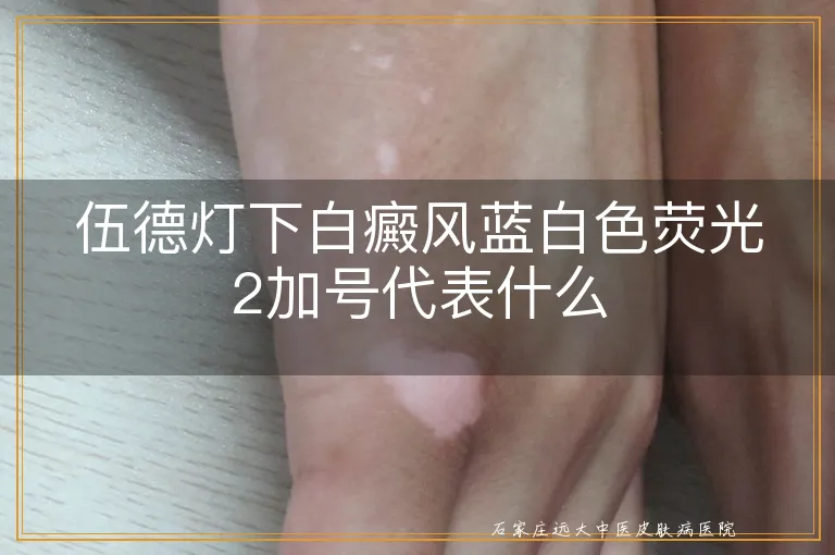 伍德灯下白癜风蓝白色荧光2加号代表什么