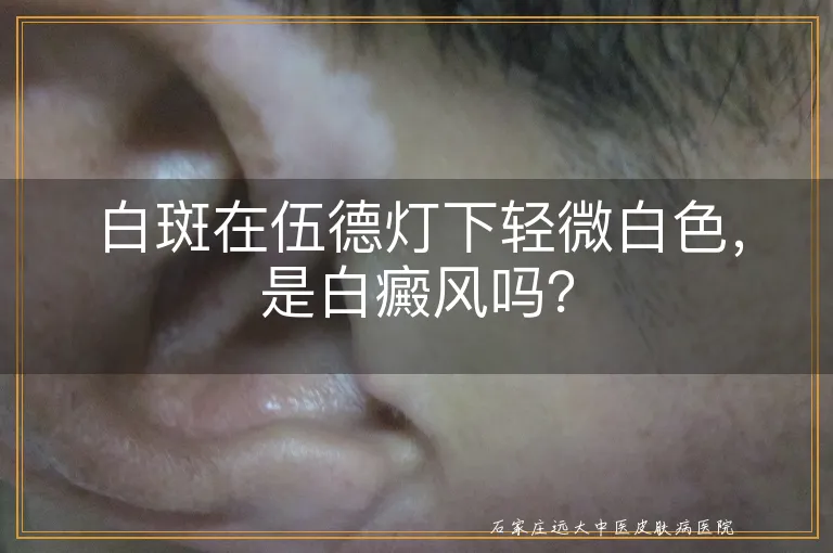 白斑在伍德灯下轻微白色，是白癜风吗？