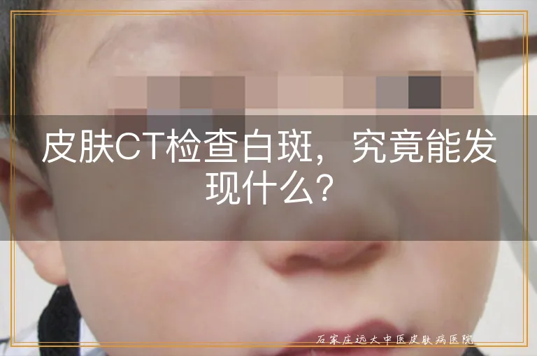 皮肤CT检查白斑，究竟能发现什么？