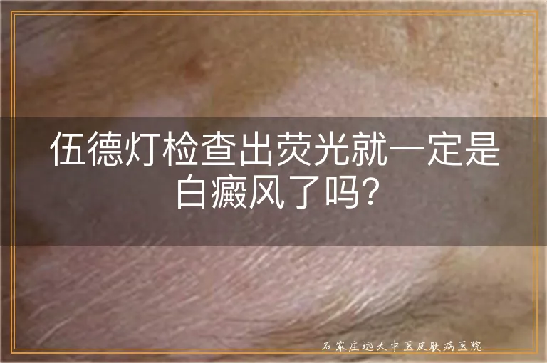 伍德灯检查出荧光就一定是白癜风了吗？