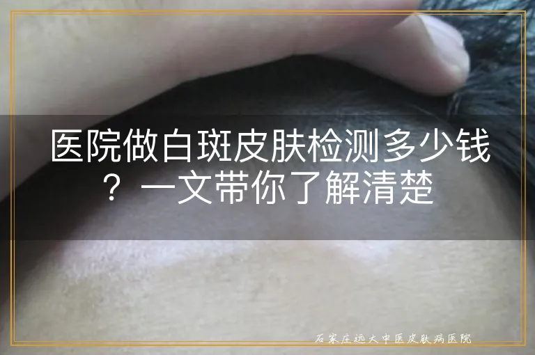 医院做白斑皮肤检测多少钱？一文带你了解清楚