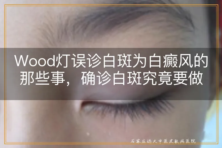 Wood灯误诊白斑为白癜风的那些事，确诊白斑究竟要做哪些检查？