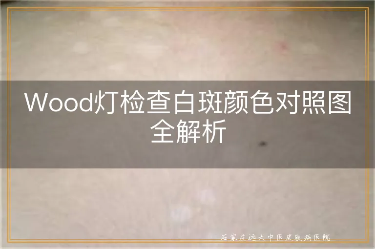 Wood灯检查白斑颜色对照图全解析