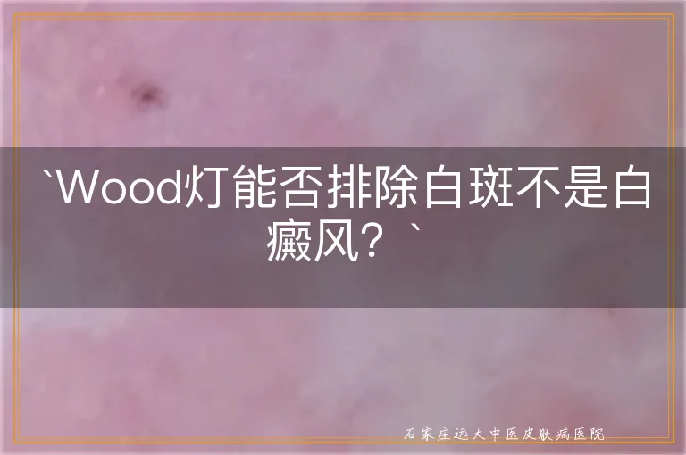 `Wood灯能否排除白斑不是白癜风？`