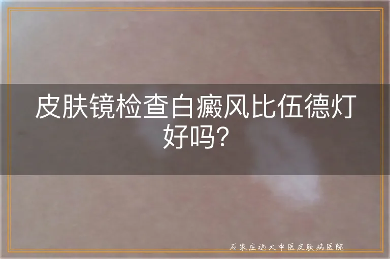 皮肤镜检查白癜风比伍德灯好吗？