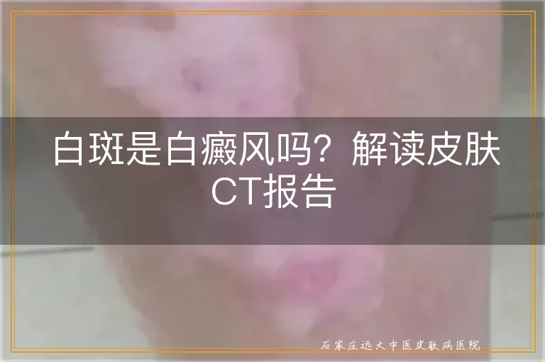 白斑是白癜风吗？解读皮肤CT报告