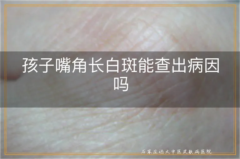 孩子嘴角长白斑能查出病因吗