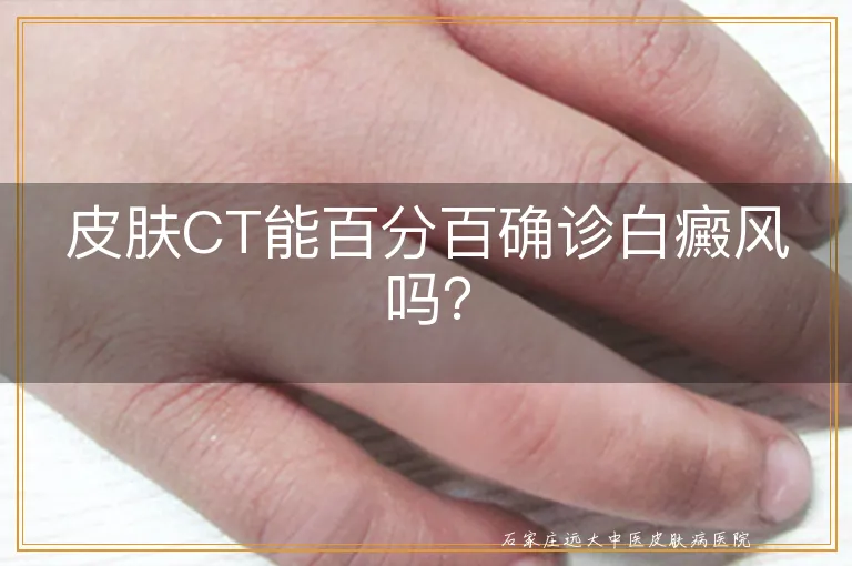 皮肤CT能百分百确诊白癜风吗？