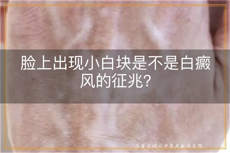 脸上出现小白块是不是白癜风的征兆？