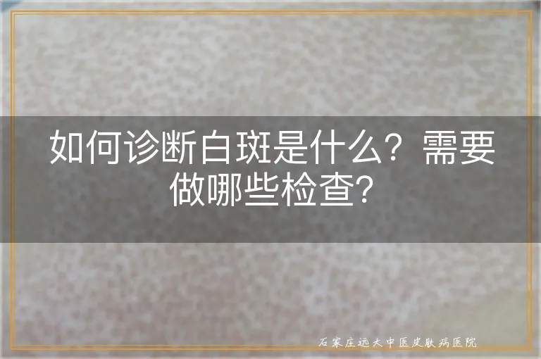 如何诊断白斑是什么？需要做哪些检查？