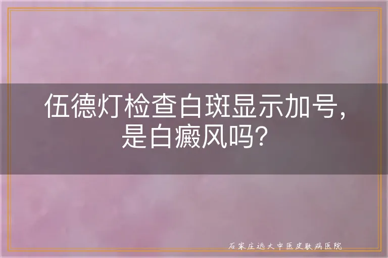 伍德灯检查白斑显示加号，是白癜风吗？