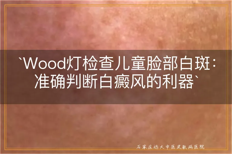 `Wood灯检查儿童脸部白斑：准确判断白癜风的利器`