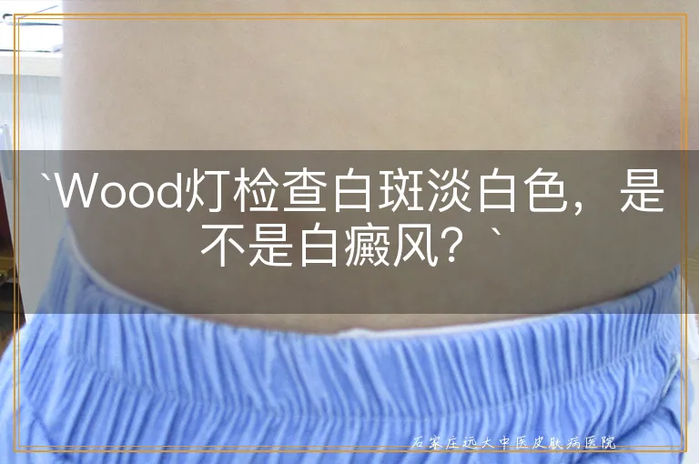 `Wood灯检查白斑淡白色，是不是白癜风？`