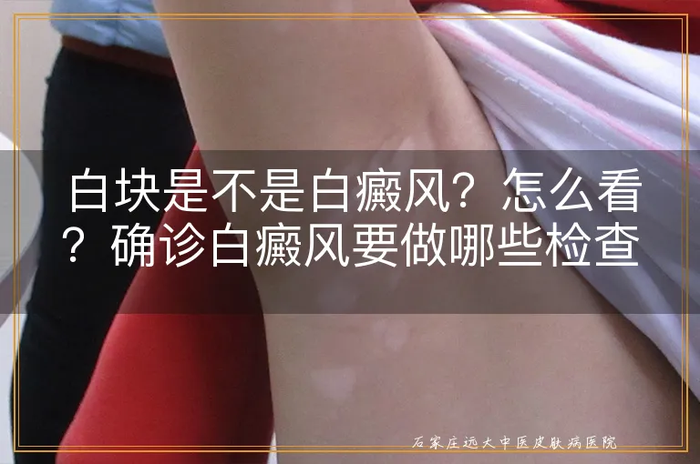 白块是不是白癜风？怎么看？确诊白癜风要做哪些检查