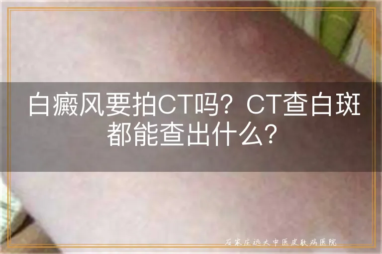 白癜风要拍CT吗？CT查白斑都能查出什么？