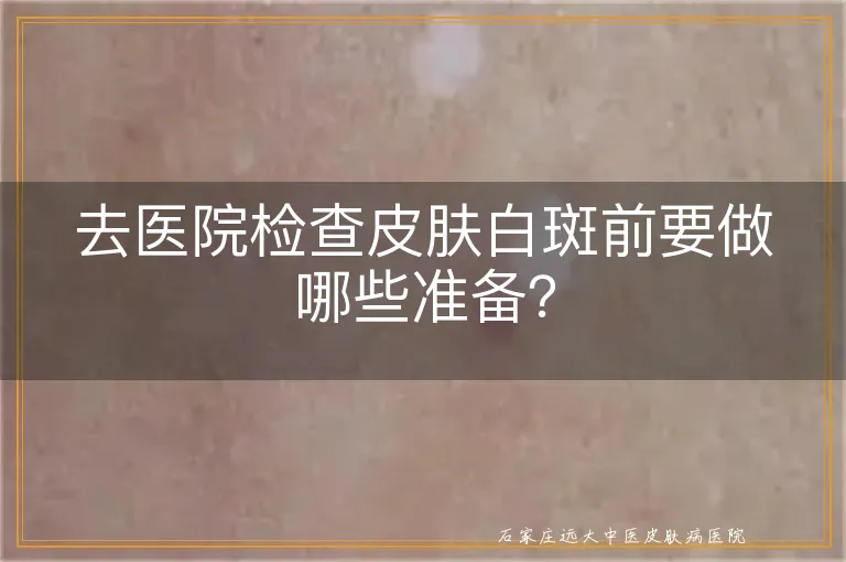 去医院检查皮肤白斑前要做哪些准备？