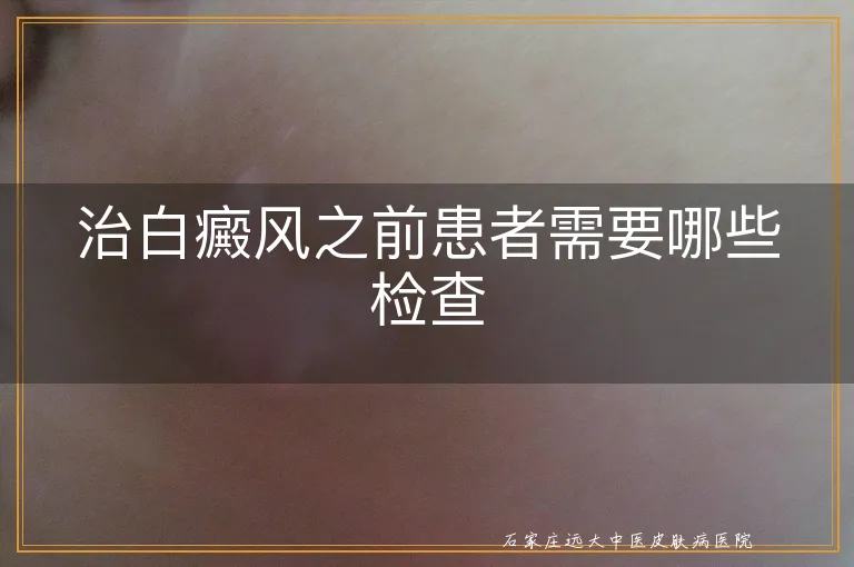 治白癜风之前患者需要哪些检查