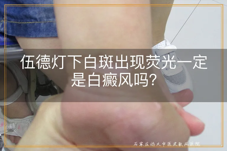 伍德灯下白斑出现荧光一定是白癜风吗？