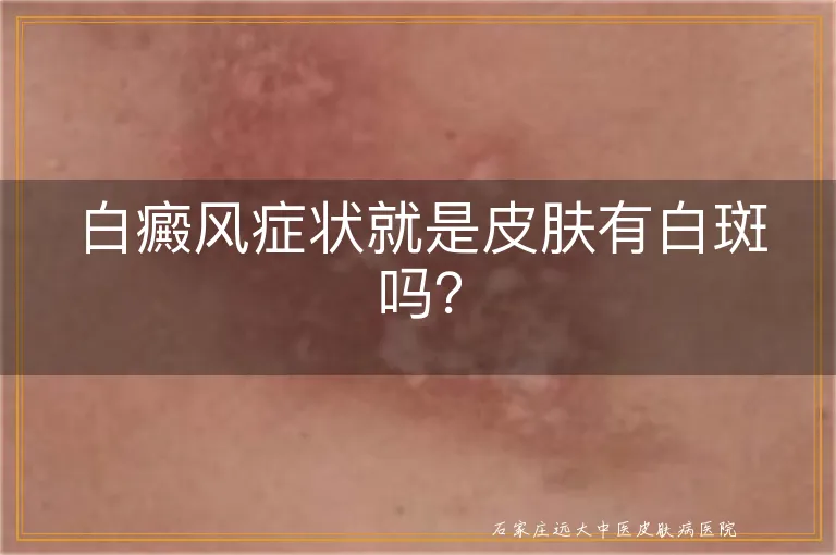 白癜风症状就是皮肤有白斑吗？