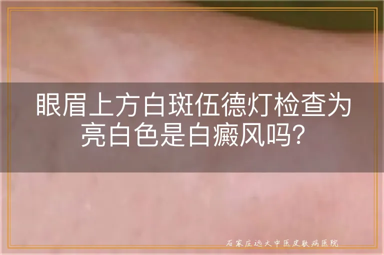 眼眉上方白斑伍德灯检查为亮白色是白癜风吗？