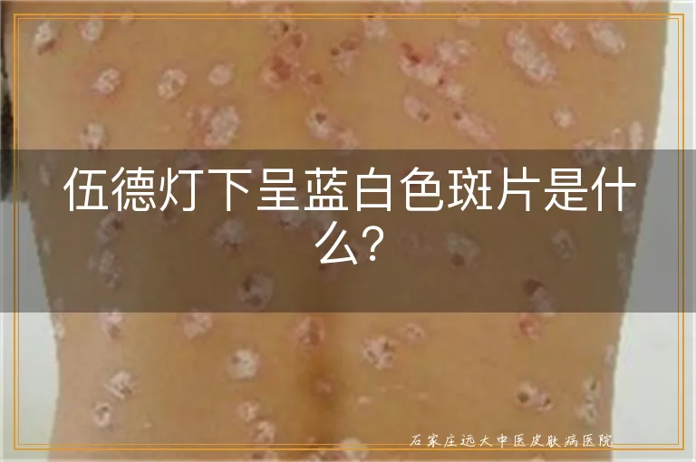 伍德灯下呈蓝白色斑片是什么？