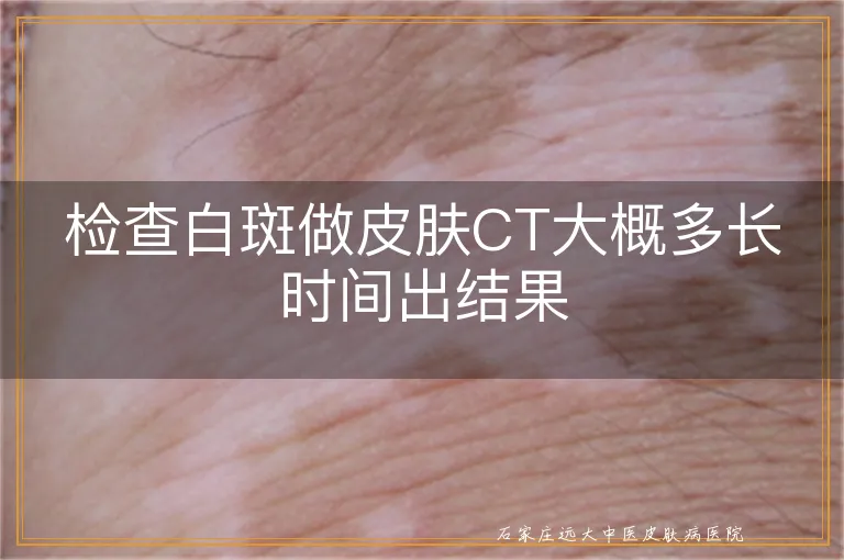 检查白斑做皮肤CT大概多长时间出结果