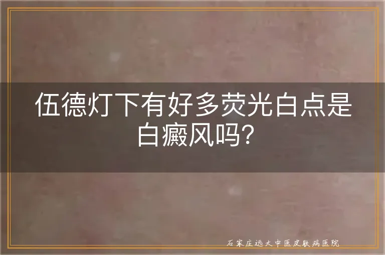 伍德灯下有好多荧光白点是白癜风吗？