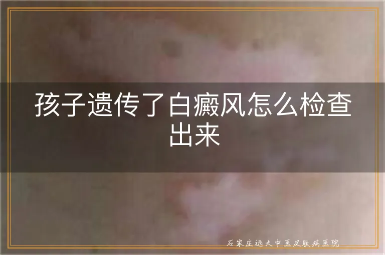 孩子遗传了白癜风怎么检查出来