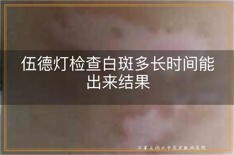 伍德灯检查白斑多长时间能出来结果