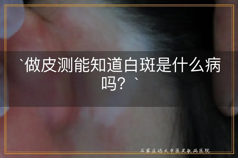 `做皮测能知道白斑是什么病吗？`