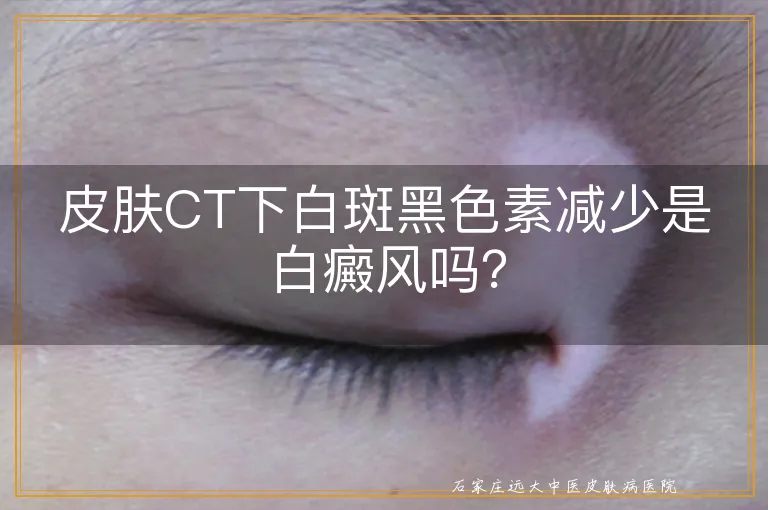 皮肤CT下白斑黑色素减少是白癜风吗？