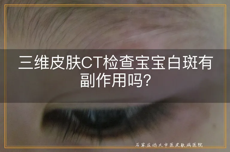 三维皮肤CT检查宝宝白斑有副作用吗？