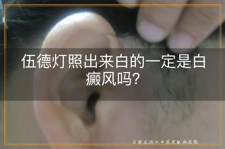 伍德灯照出来白的一定是白癜风吗？