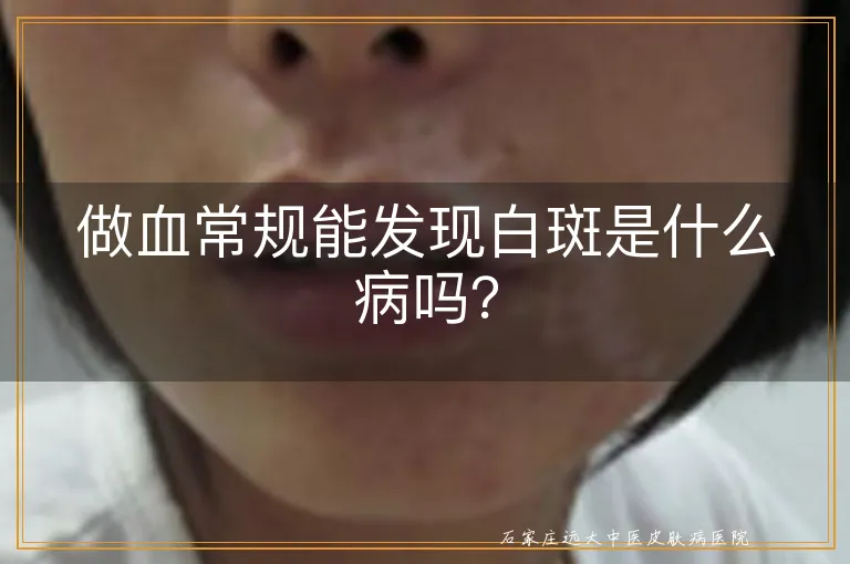 做血常规能发现白斑是什么病吗？