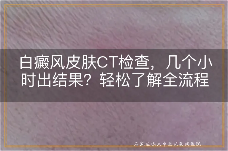 白癜风皮肤CT检查，几个小时出结果？轻松了解全流程！