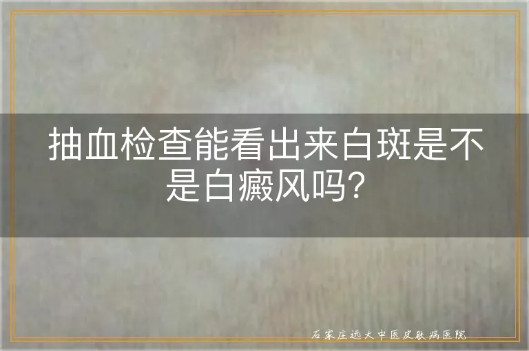 抽血检查能看出来白斑是不是白癜风吗？