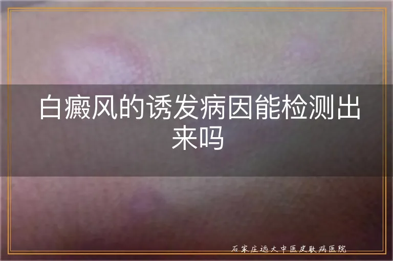 白癜风的诱发病因能检测出来吗