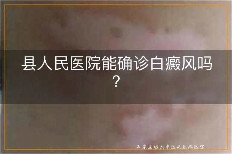 县人民医院能确诊白癜风吗？