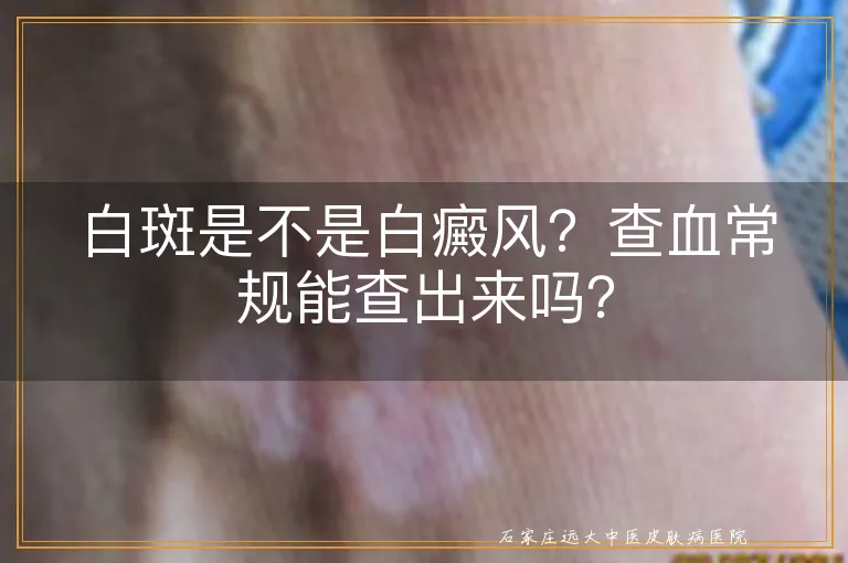 白斑是不是白癜风？查血常规能查出来吗？