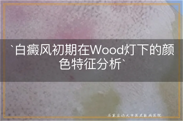 白癜风初期在Wood灯下的颜色特征分析