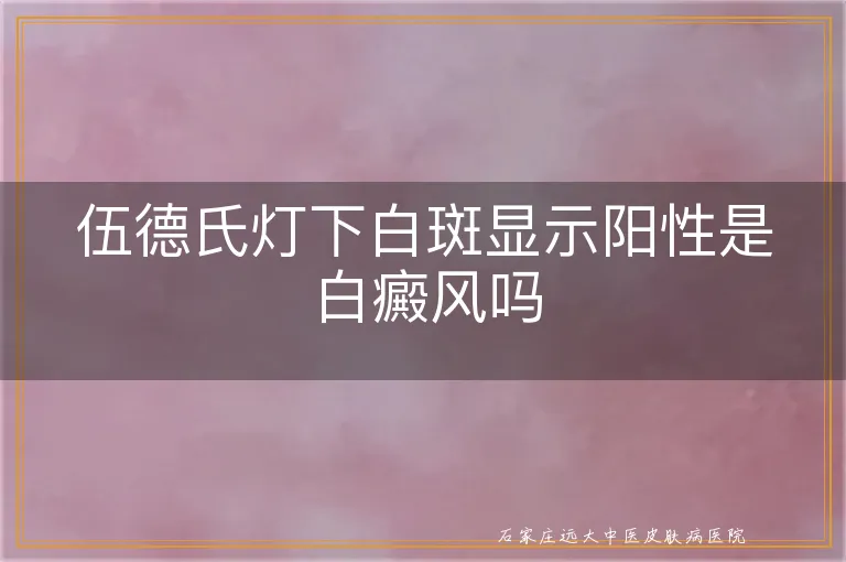 伍德氏灯下白斑显示阳性是白癜风吗