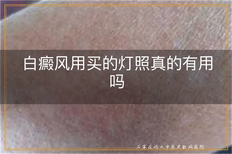 白癜风用买的灯照真的有用吗