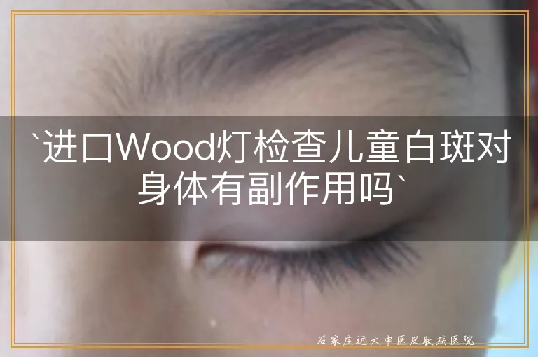 `进口Wood灯检查儿童白斑对身体有副作用吗`