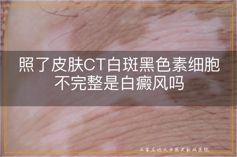 照了皮肤CT白斑黑色素细胞不完整是白癜风吗