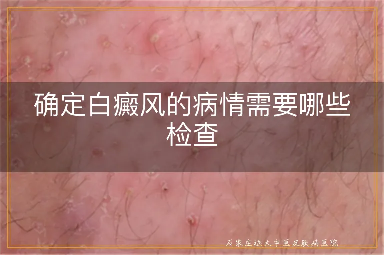 确定白癜风的病情需要哪些检查