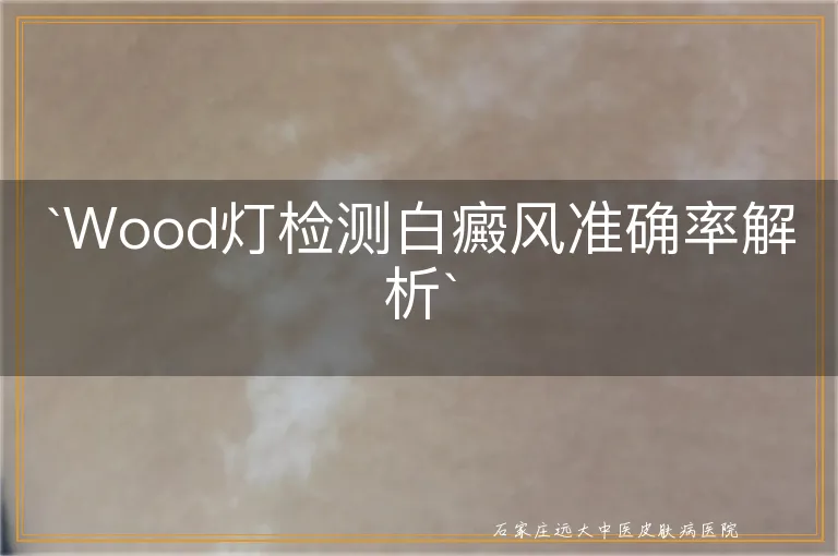 `Wood灯检测白癜风准确率解析`