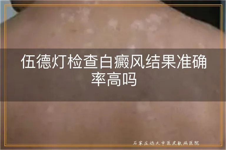 伍德灯检查白癜风结果准确率高吗