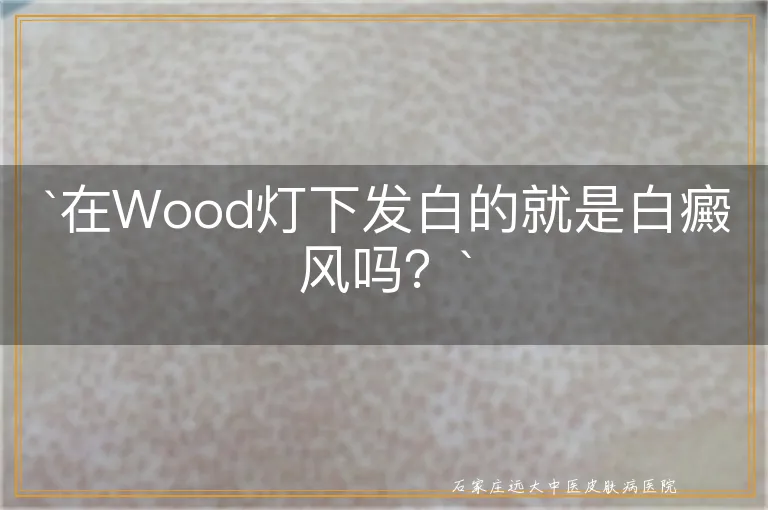 `在Wood灯下发白的就是白癜风吗？`