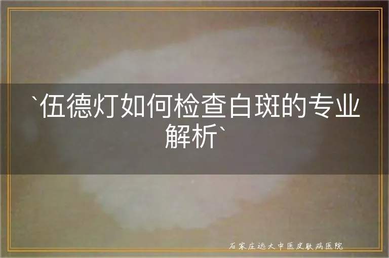 `伍德灯如何检查白斑的专业解析`