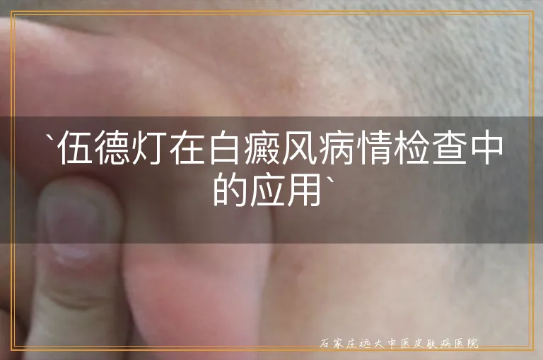 `伍德灯在白癜风病情检查中的应用`